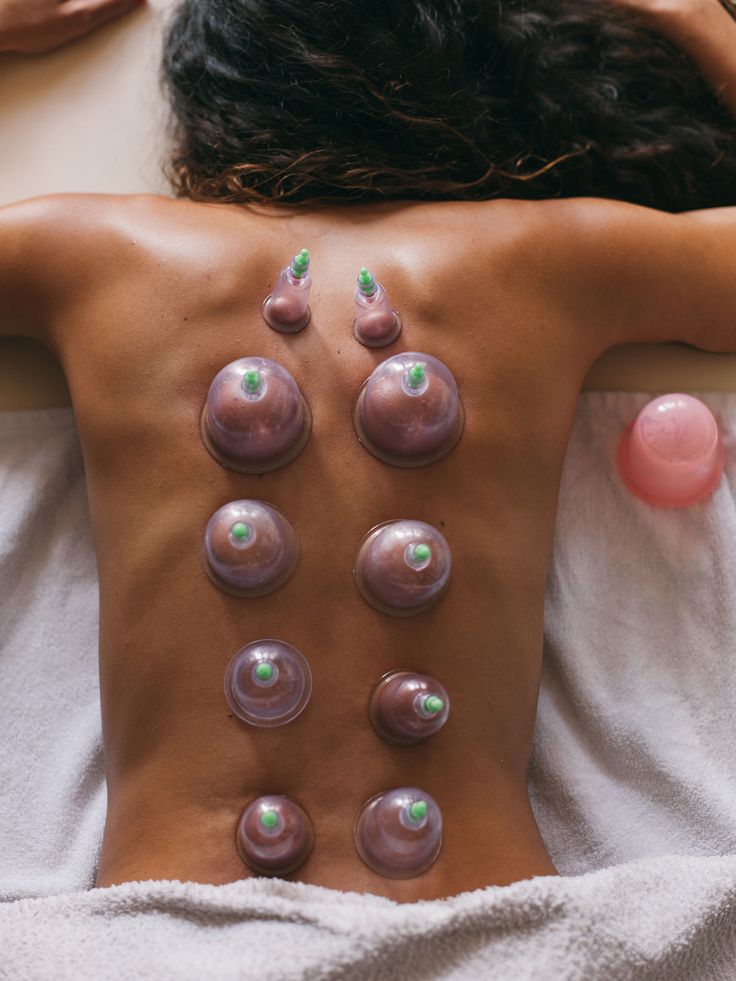 Cupping therapy